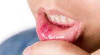 吃博洋瓜口腔疼,揭秘夏日消暑美食的甜蜜烦恼